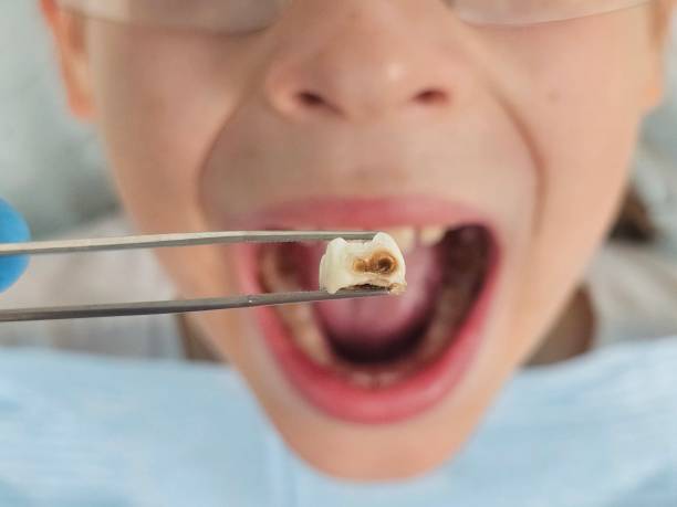 Best Dental Abscess Treatment in Seymour, TX